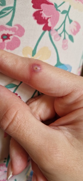 What in the name is this on my finger? (horrible photo attached)
