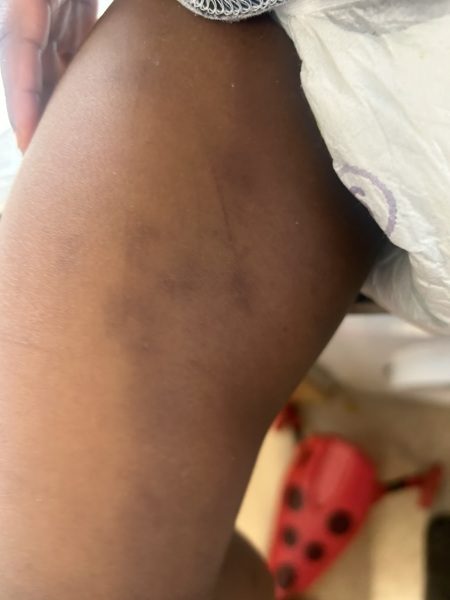What could these bruises or dark marks be on child skin