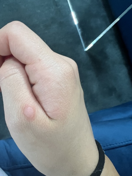 What is this on my knuckle?
