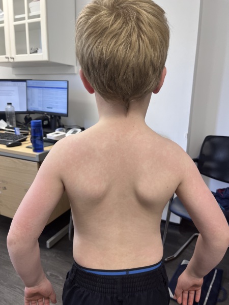 Hayfever presenting as rash on face and back?