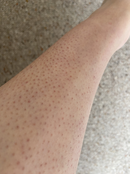 Strawberry legs and general bad skin all over - help!