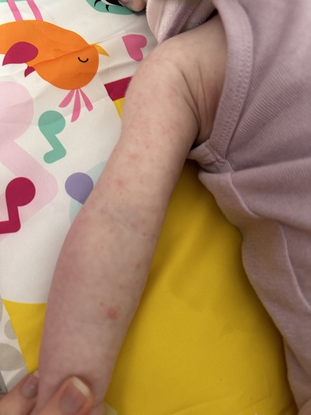 sweat rash/heat rash