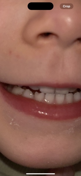 What is the cause of this dent in DD tooth?!