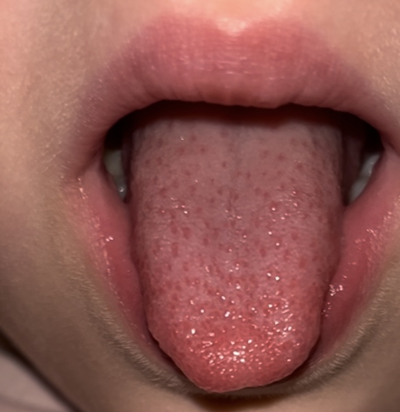 Help. Is this strawberry tongue?