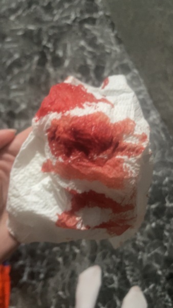 *TW BLOOD*This is a miscarriage isn’t it ?
