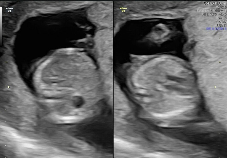 Told boy at 15 weeks and girl at 20 week scan