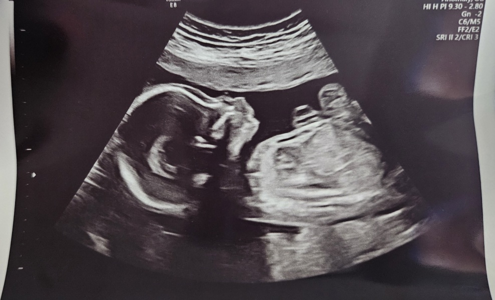 Told boy at 15 weeks and girl at 20 week scan