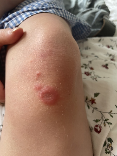 To be mildly concerned about this rash / bite