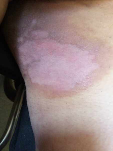 Any Ideas What This Skin Complaint Is? Candida? Warning pics included