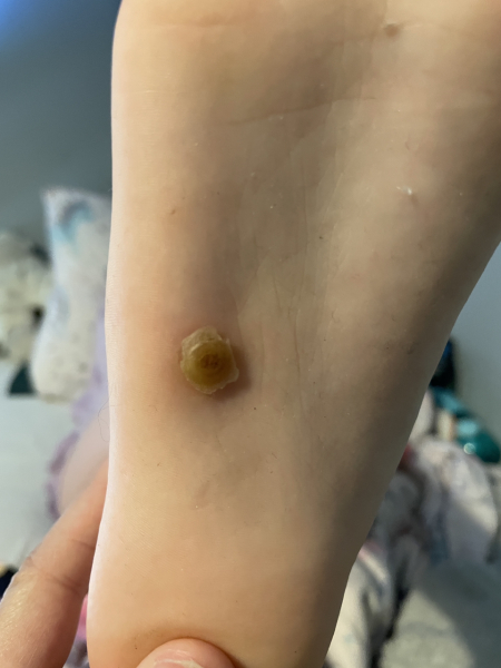 Help with very stubborn child attached to stubborn verucca!