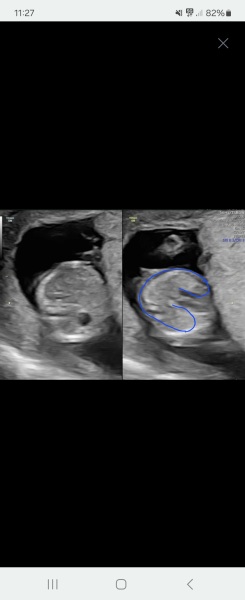 Told boy at 15 weeks and girl at 20 week scan