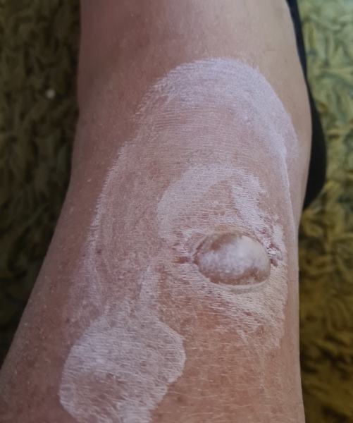 What has bitten me? Warning: pic's included