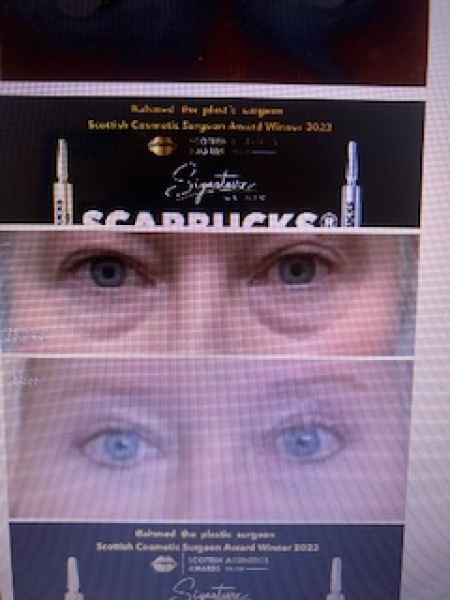 Under eye aesthetic treatment that worked