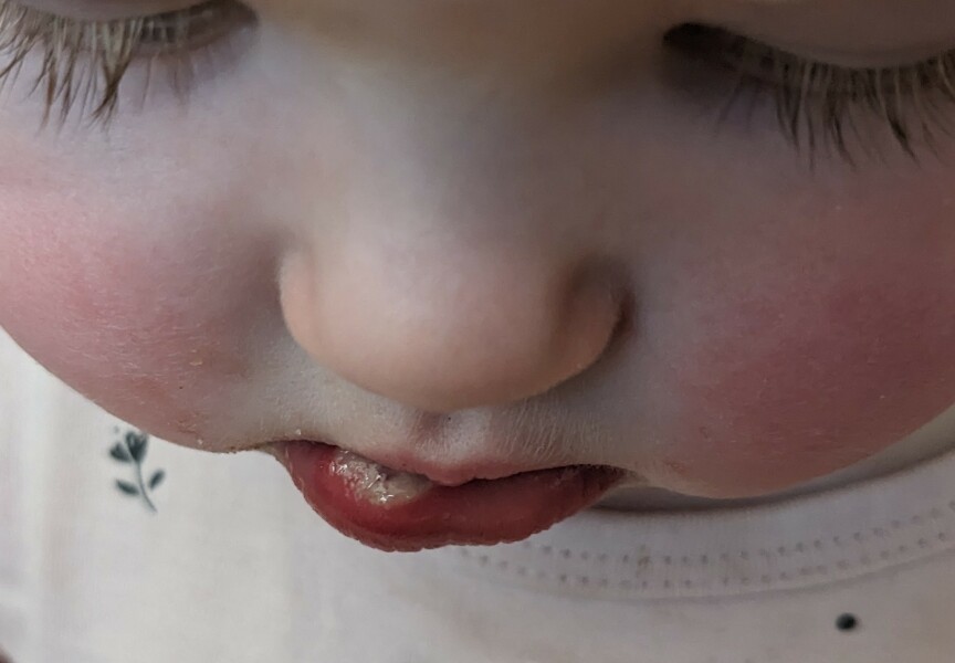 Toddler cut lip ulcerated