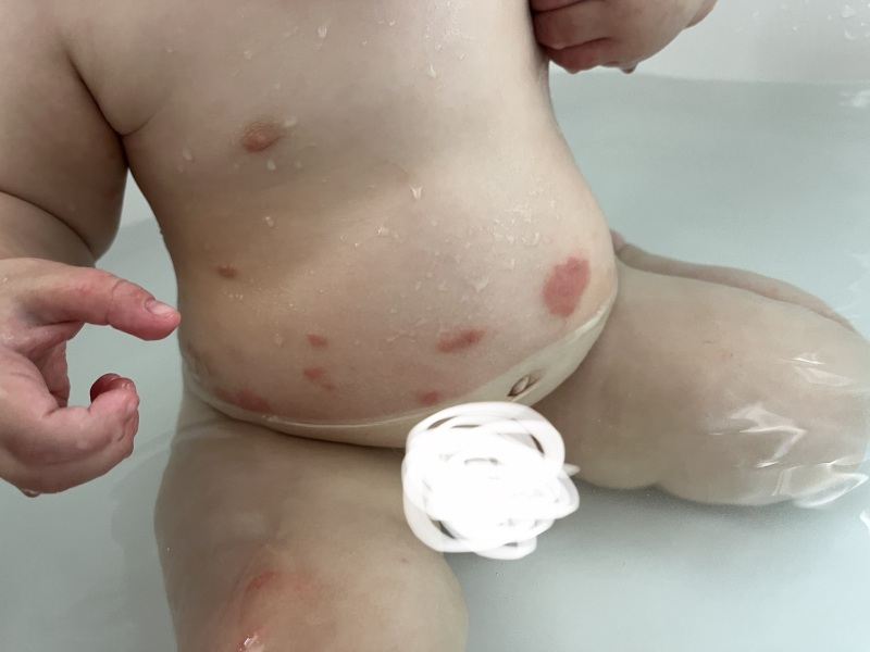 Is this even eczema?! Photo attached!