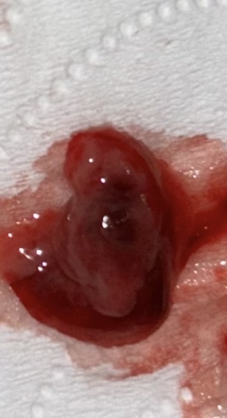 Miscarriage, unknown gestation *photo*