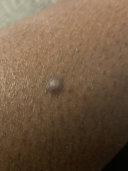 I’m so worried this is a skin cancer