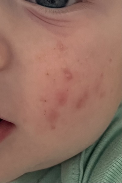 Infantile Acne / Baby Acne at 5 months