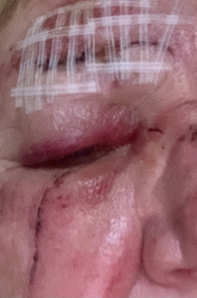 Fell on my Face! Help!