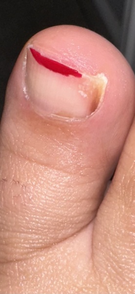 Photo warning Fungal toenail or subungual melanoma? HeLp!!