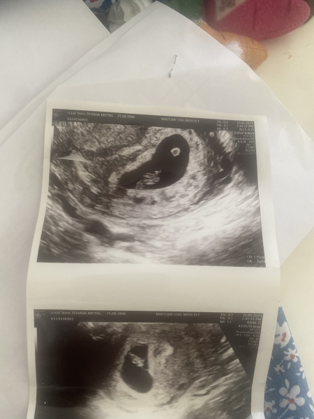 Early scan, twins?