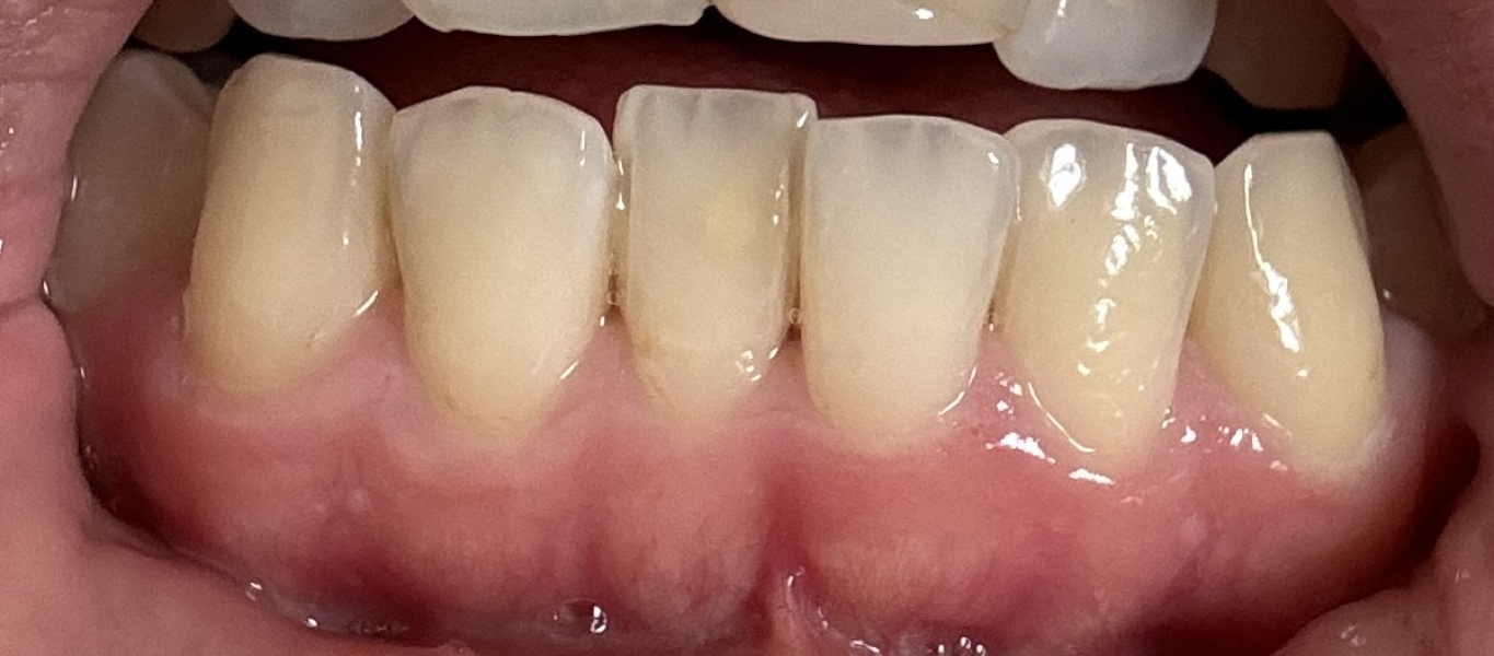 Inflamed Gums