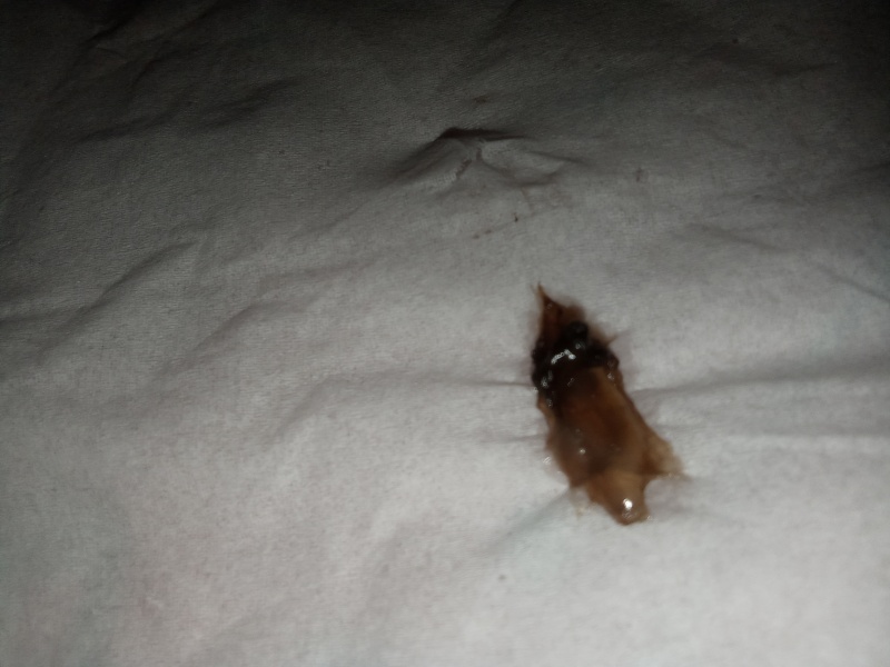 Miscarriage or blood clot? 