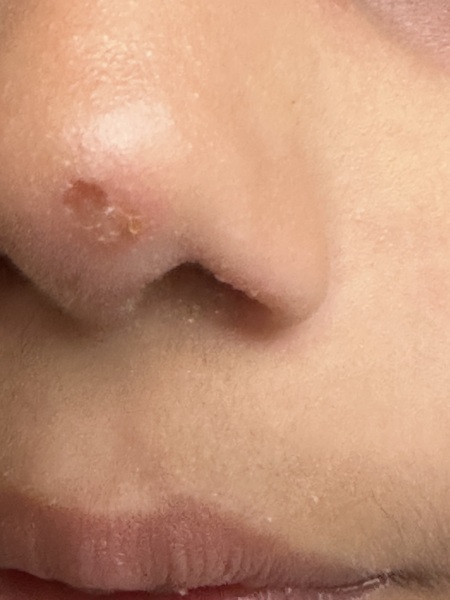 Red spot/crator on nose and eyes