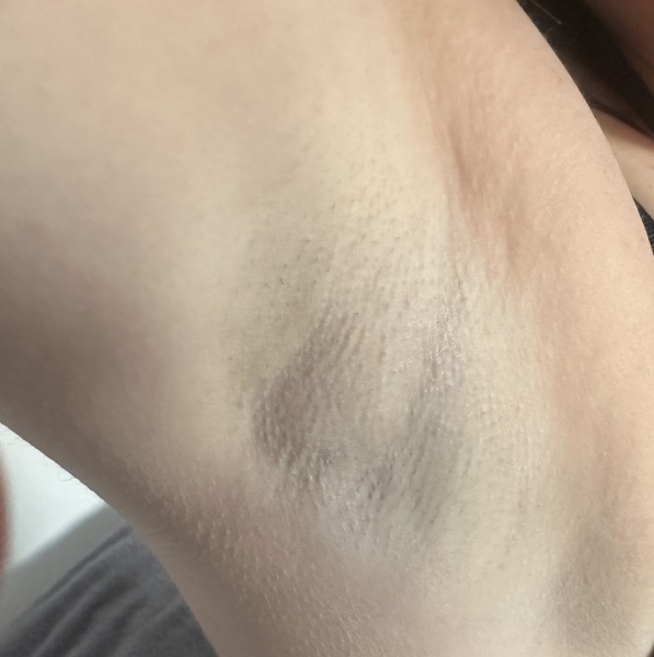 Lump in armpit