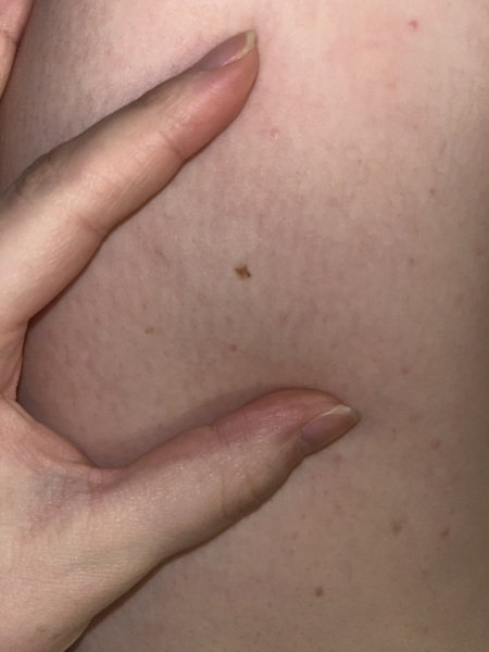 Would you be worried about this freckle/mole?