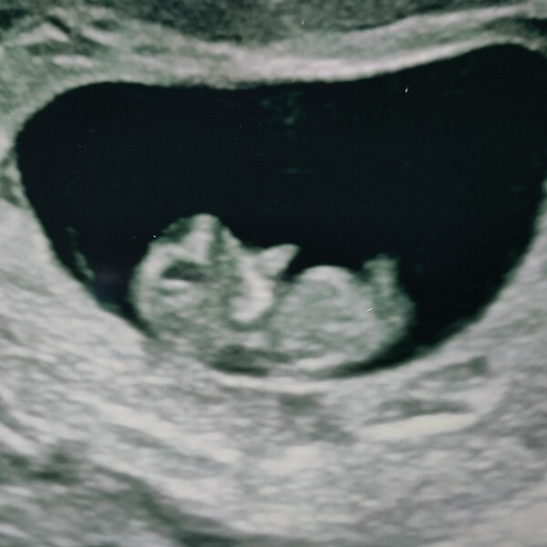 Can I see your 8-10 weeks scans
