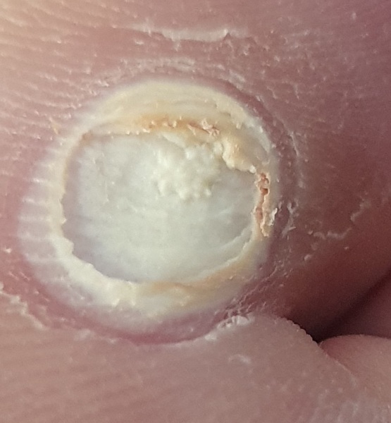 Is this a verruca still?? Picture attached