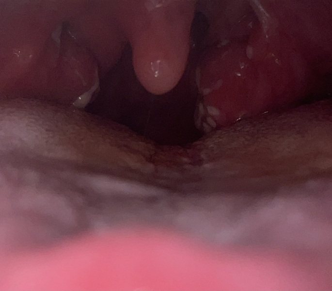 Tonsillitis - gross photo alert