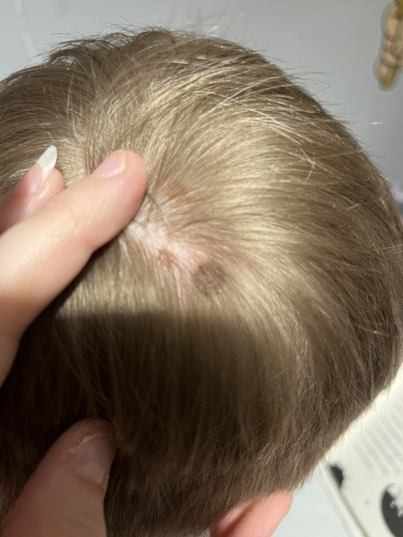 Sons head- mole?