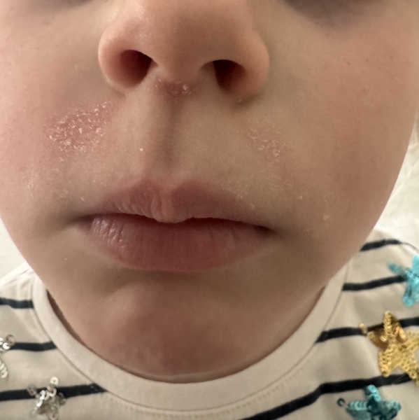 Persistent Fungal Infection