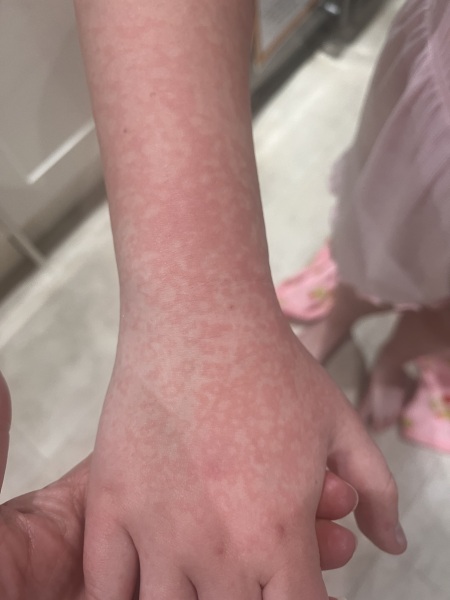 parvovirus