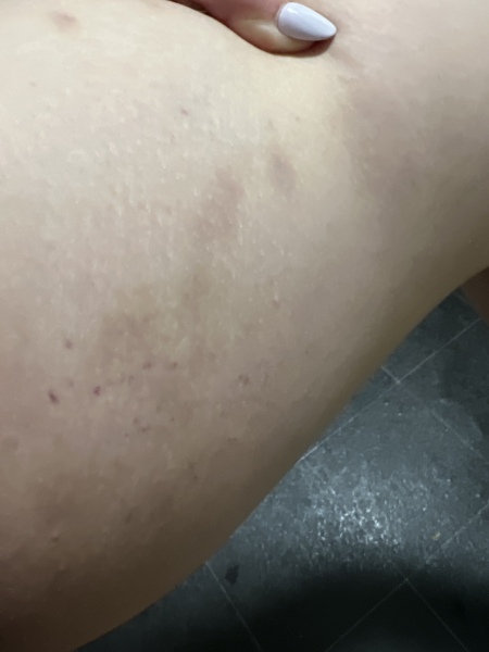 Itching and bruising