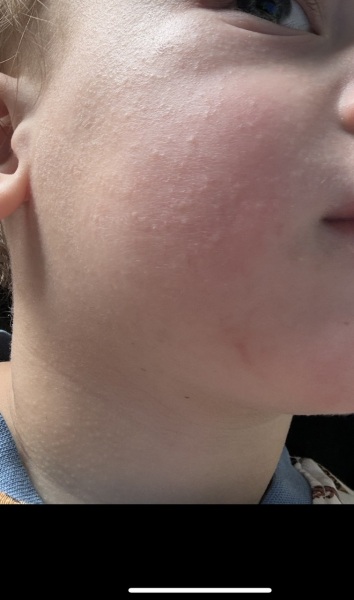 Reaction to sun cream? I think? See photo