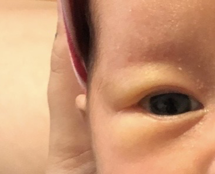 Bags/creases under newborns eyes (1 week). Does this look normal?