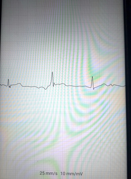 Can anyone have a look at this EKG??