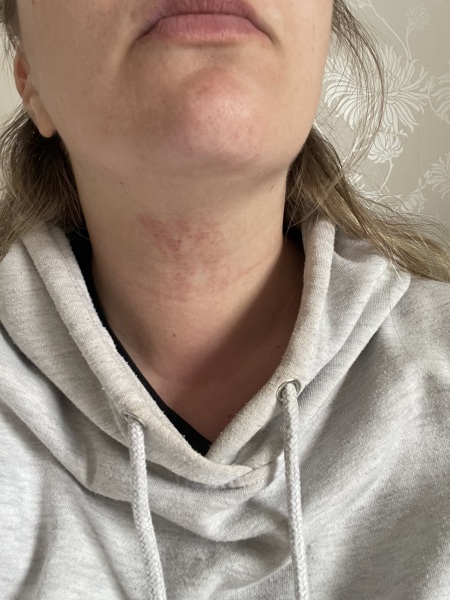 Rash on neck early pregnancy
