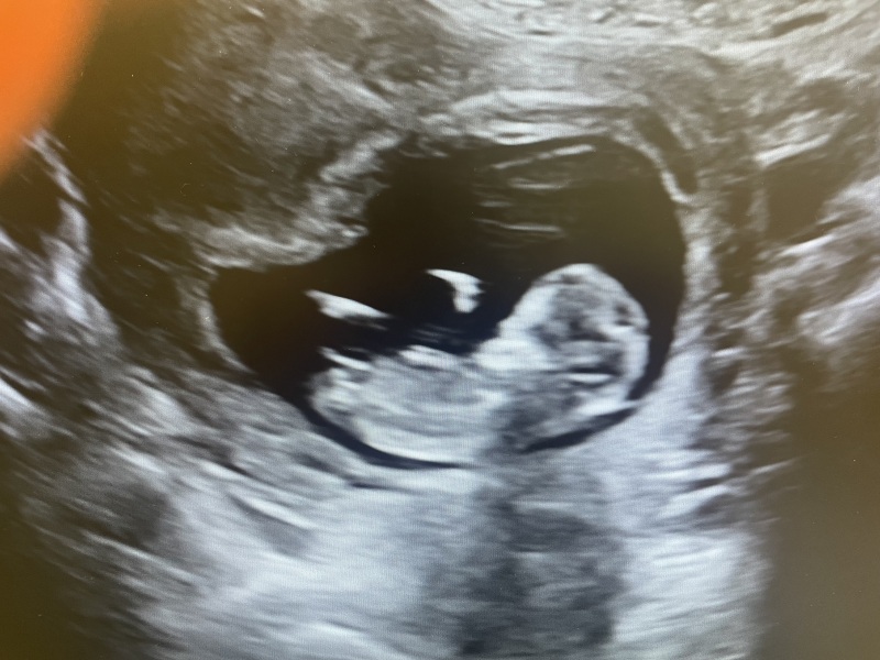 11 week scan - nub theory 