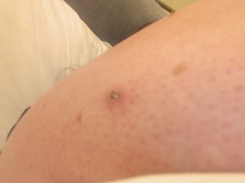 Mole and Antibiotics