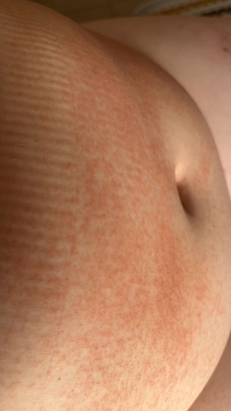 Rash after c section??