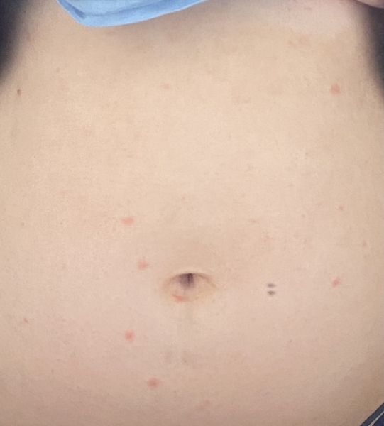 Rash in pregnancy??