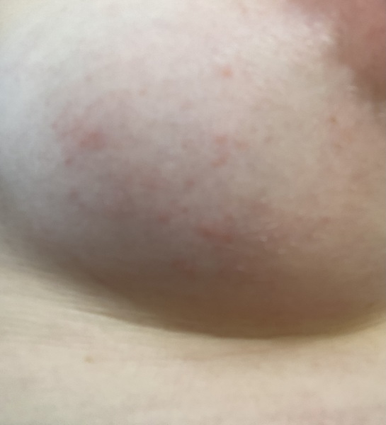 Rash on boob, 16 weeks pregnant - eczema, fungal, or stretch marks?