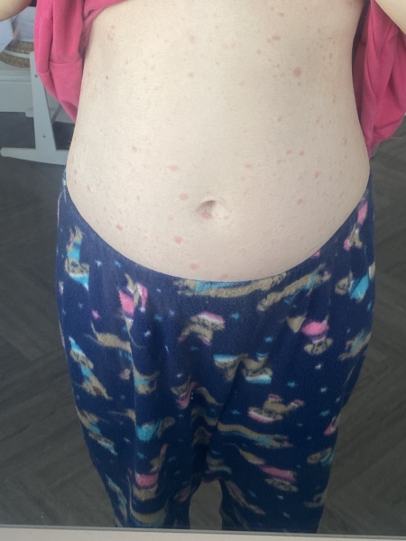 Rash in pregnancy anybody help?! 😩😩