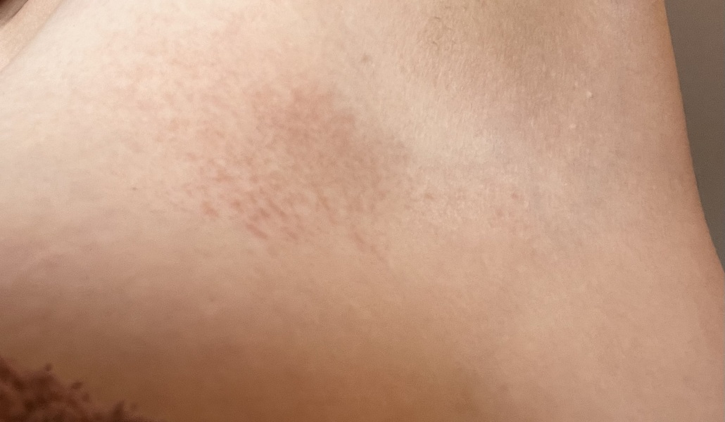 Discolour/ rash?