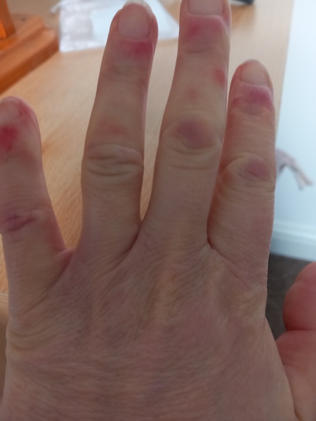 Spots on fingers