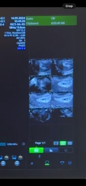 7weeks pregnant but bby measuring 6w 1d